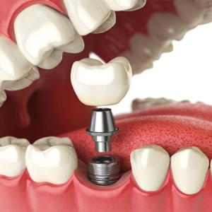 implantes e próteses implantes e próteses